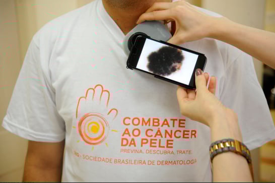 Dezembro Laranja conscientiza para prevenção ao câncer de pele