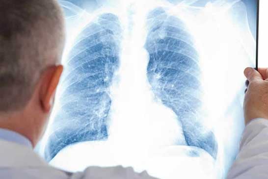 Aparelho desenvolvido em Araxá busca melhorar respiração de paciente com patologias pulmonares